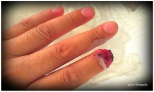 Amputacion do dedo íncide como consecuencia do accidente